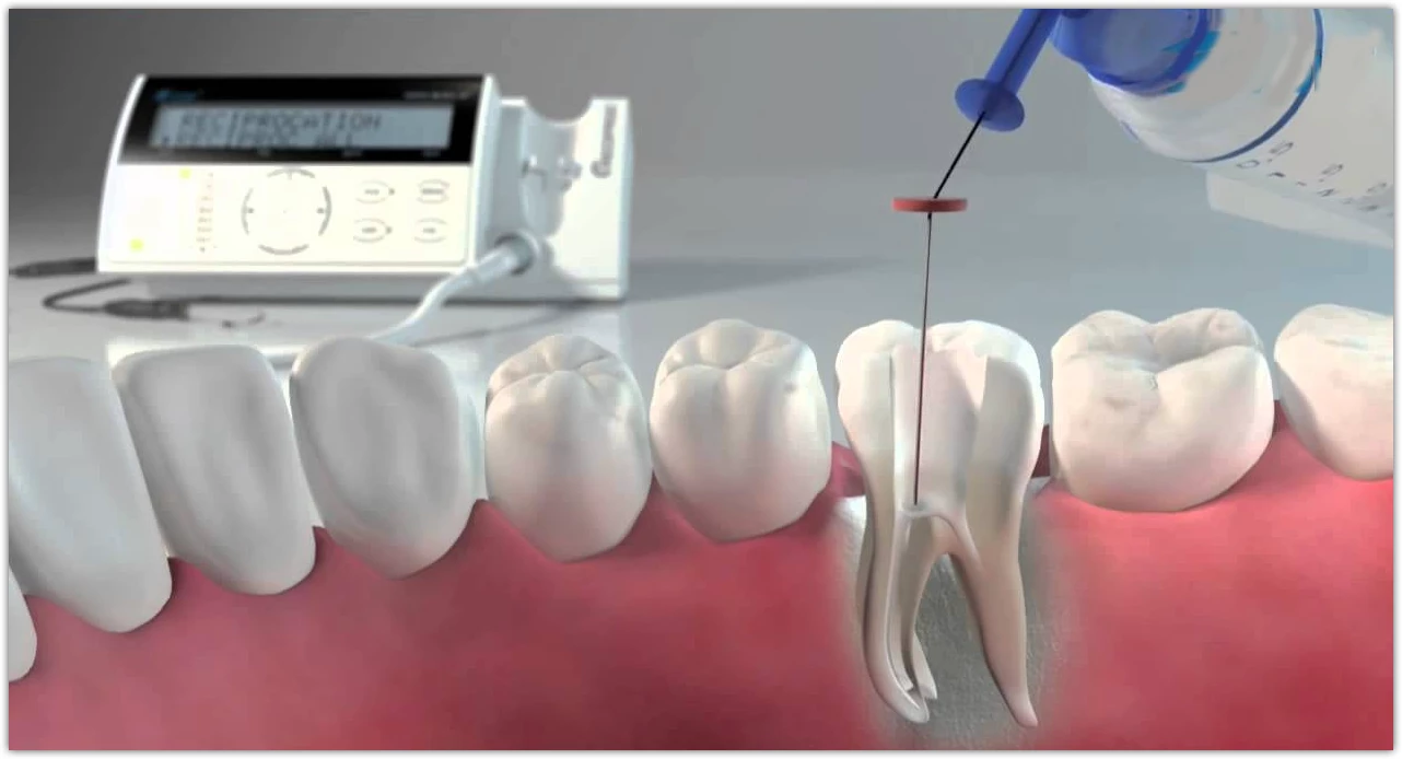 лікування кореневих каналів