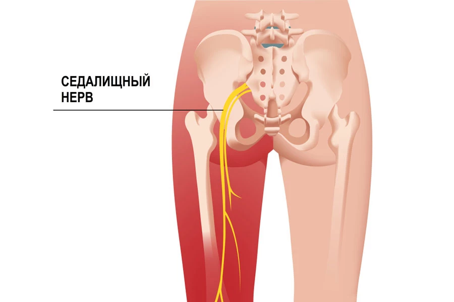 лечение седалищного нерва