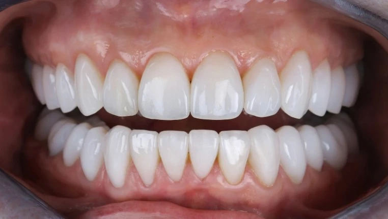 восстановление зубов после удара протезы