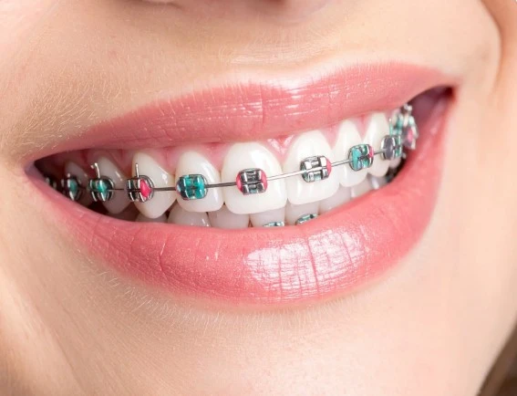 виды брекетов Алматы сравнение