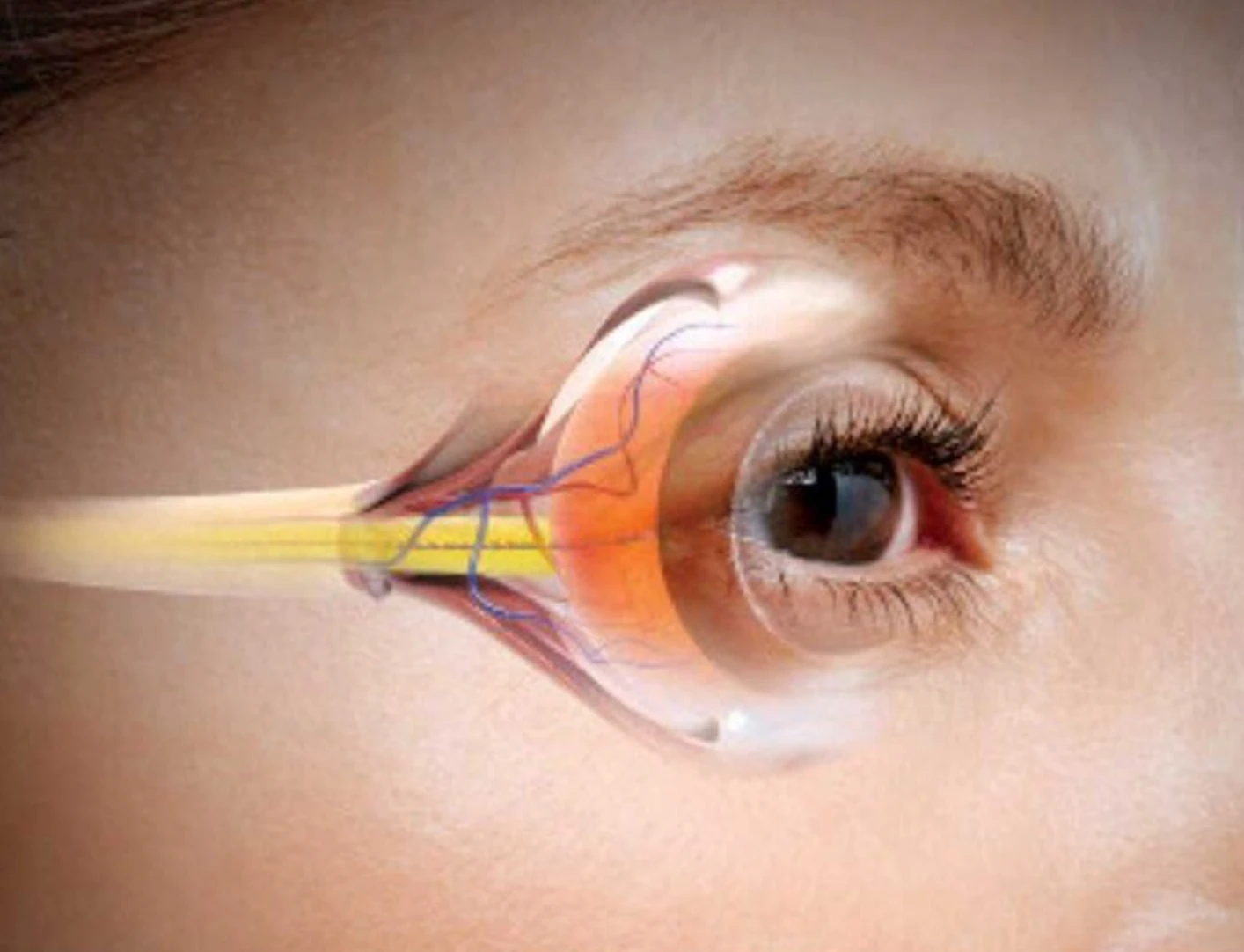 Наслідки несвоєчасного лікування глаукоми: що чекає на пацієнта? Наслідки несвоєчасного лікування глаукоми: що чекає на пацієнта?