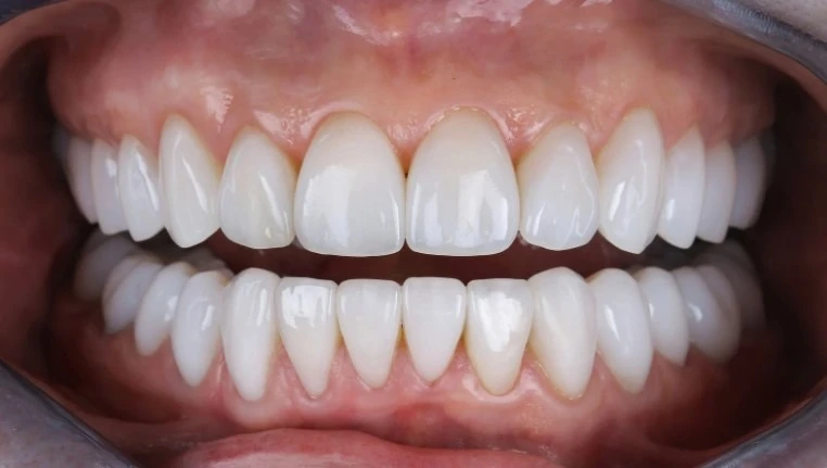 Почему имплантация зубов – это не только о красоте, но и о здоровье 2 имплантация: польза для организма