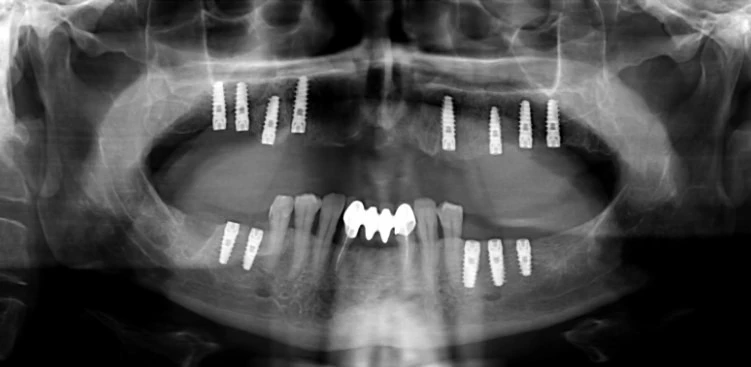 Почему имплантация зубов – это не только о красоте, но и о здоровье 3 зубные импланты и профилактика заболеваний полости рта