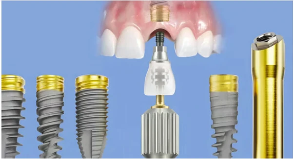 Nobel Biocare: імплантація швейцарської точності для вашої усмішки Nobel Biocare: імплантація швейцарської точності для вашої усмішки