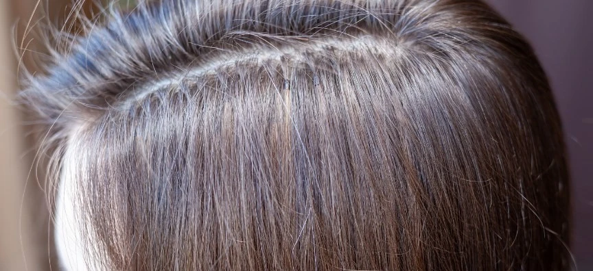 can nano bonds cause hair thinning