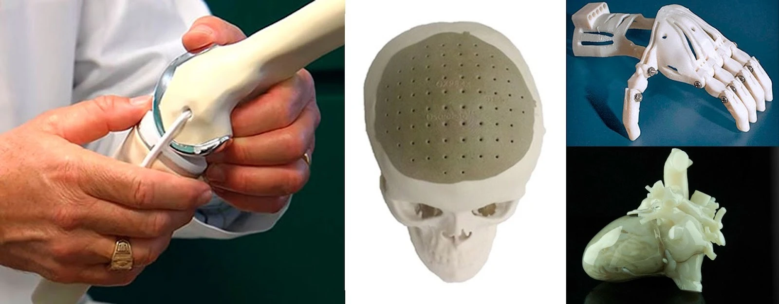 Як 3D-друк використовується для ортопедичних операцій 5 69a97e50057a4.webp