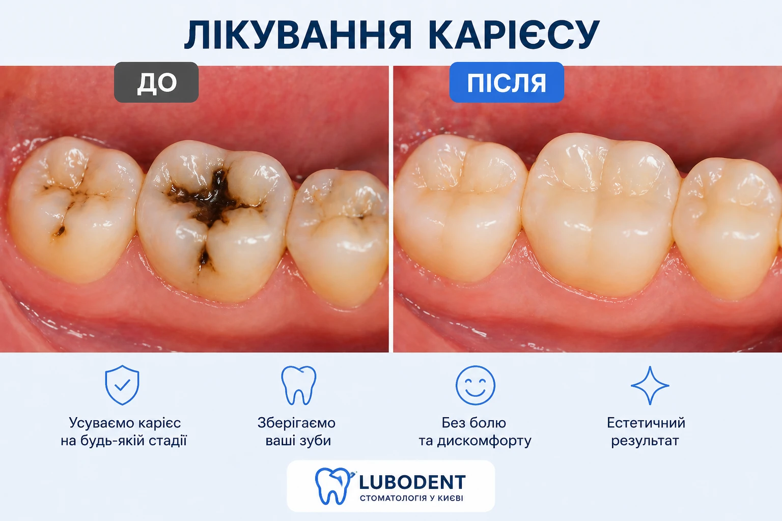лікування карієсу до і після фото стоматологія Київ Lubodent