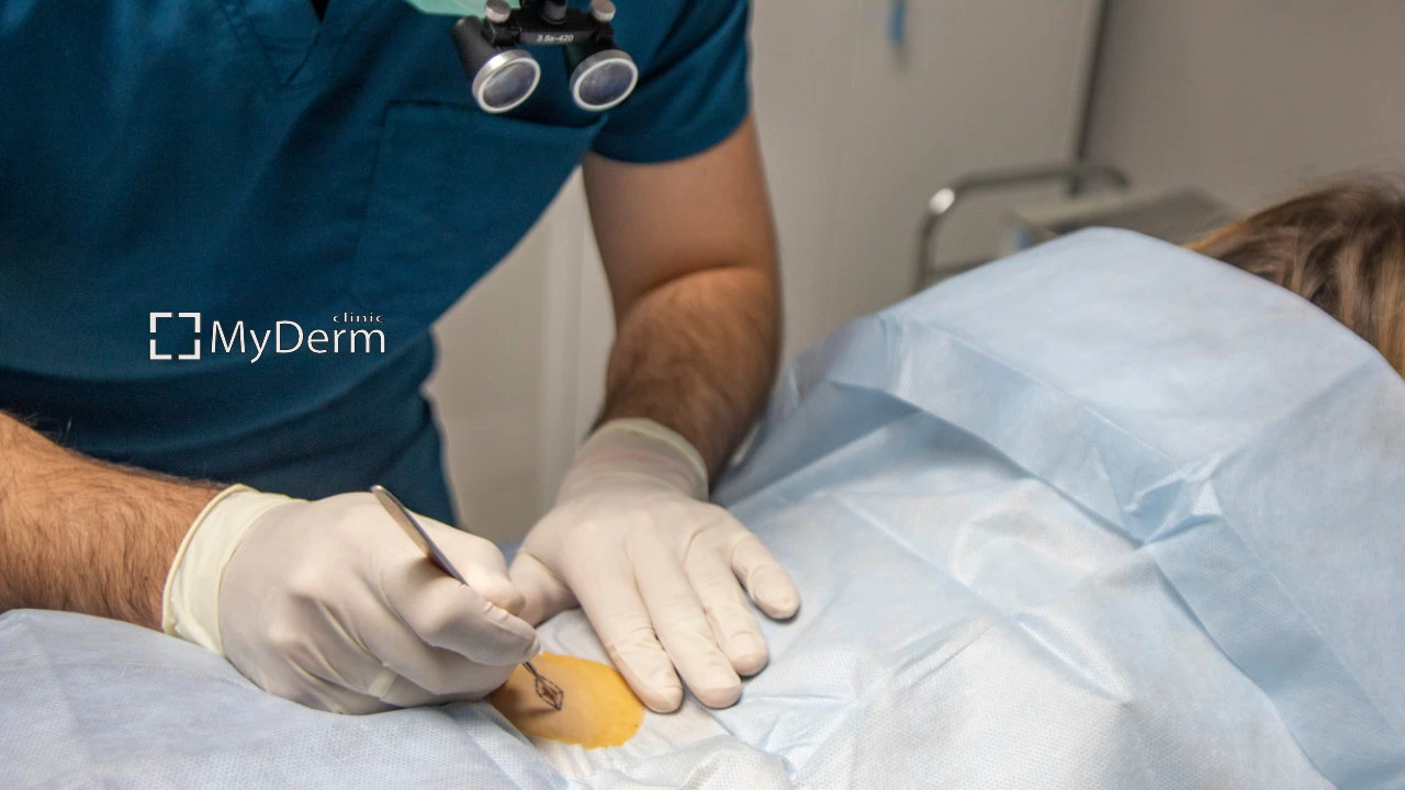 видалення новоутворень в MyDerm